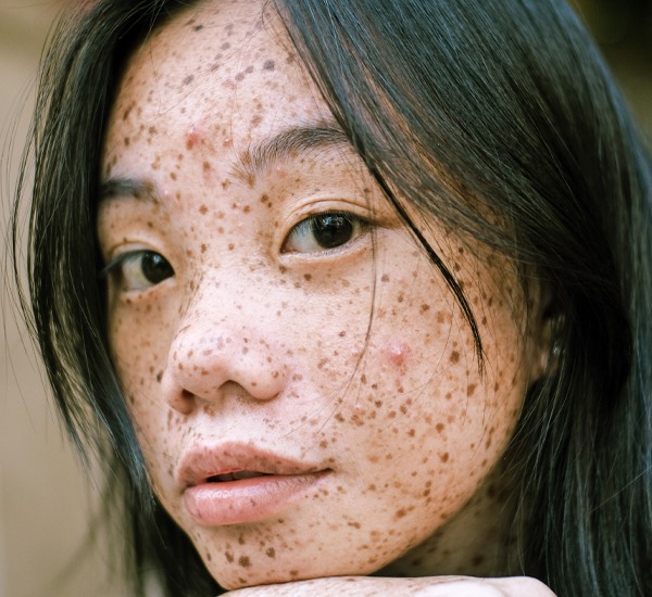 Woman with acne blemished skin