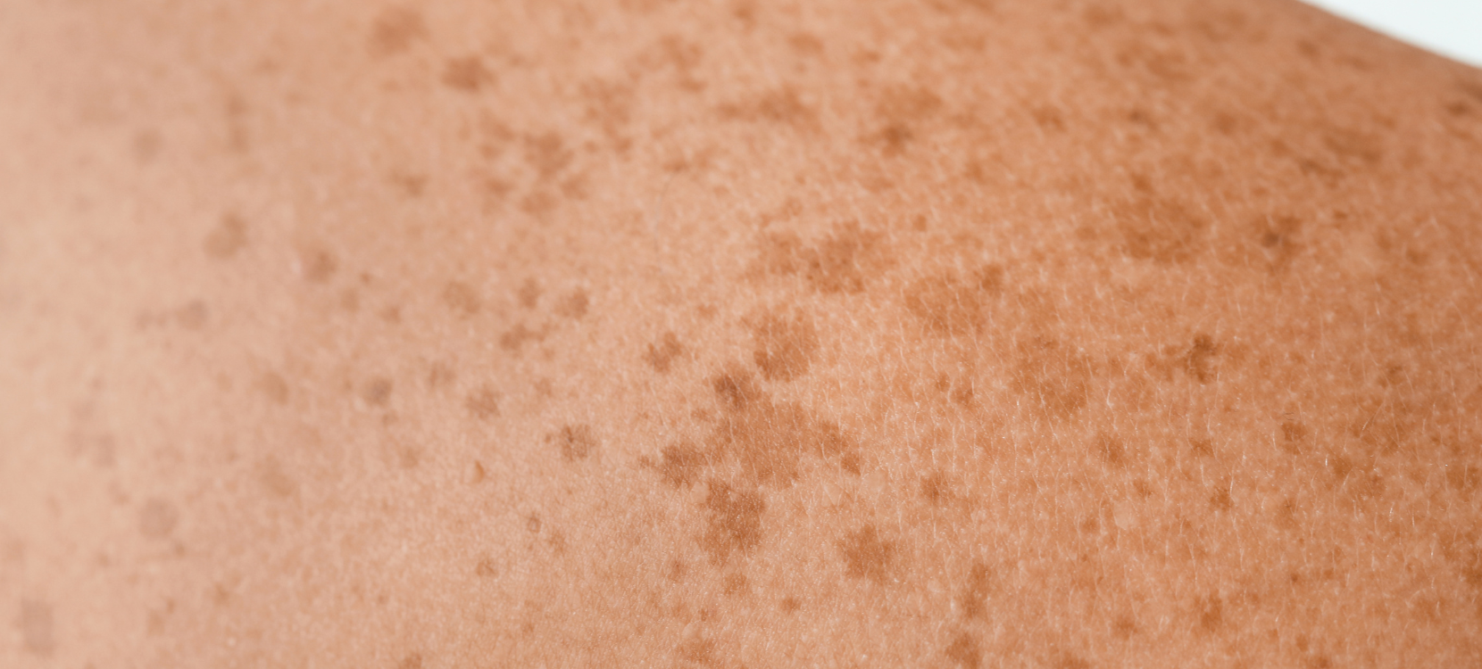 Why does the sun damage my skin?
