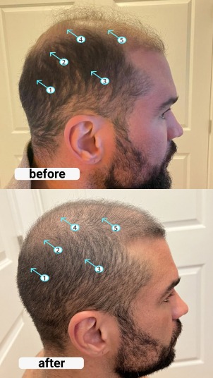 Spectral Men's (DNC-N) | Hair Density Serum with Nanoxidil® 5%