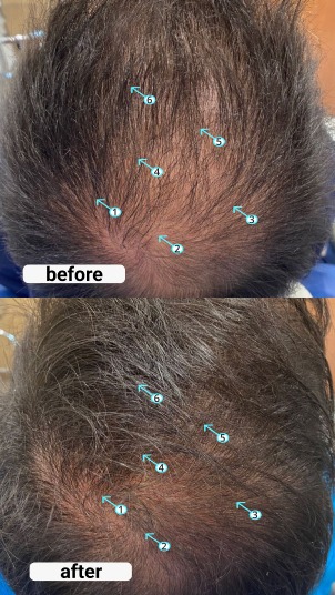 Revita | TABLETS FOR HAIR GROWTH SUPPORT