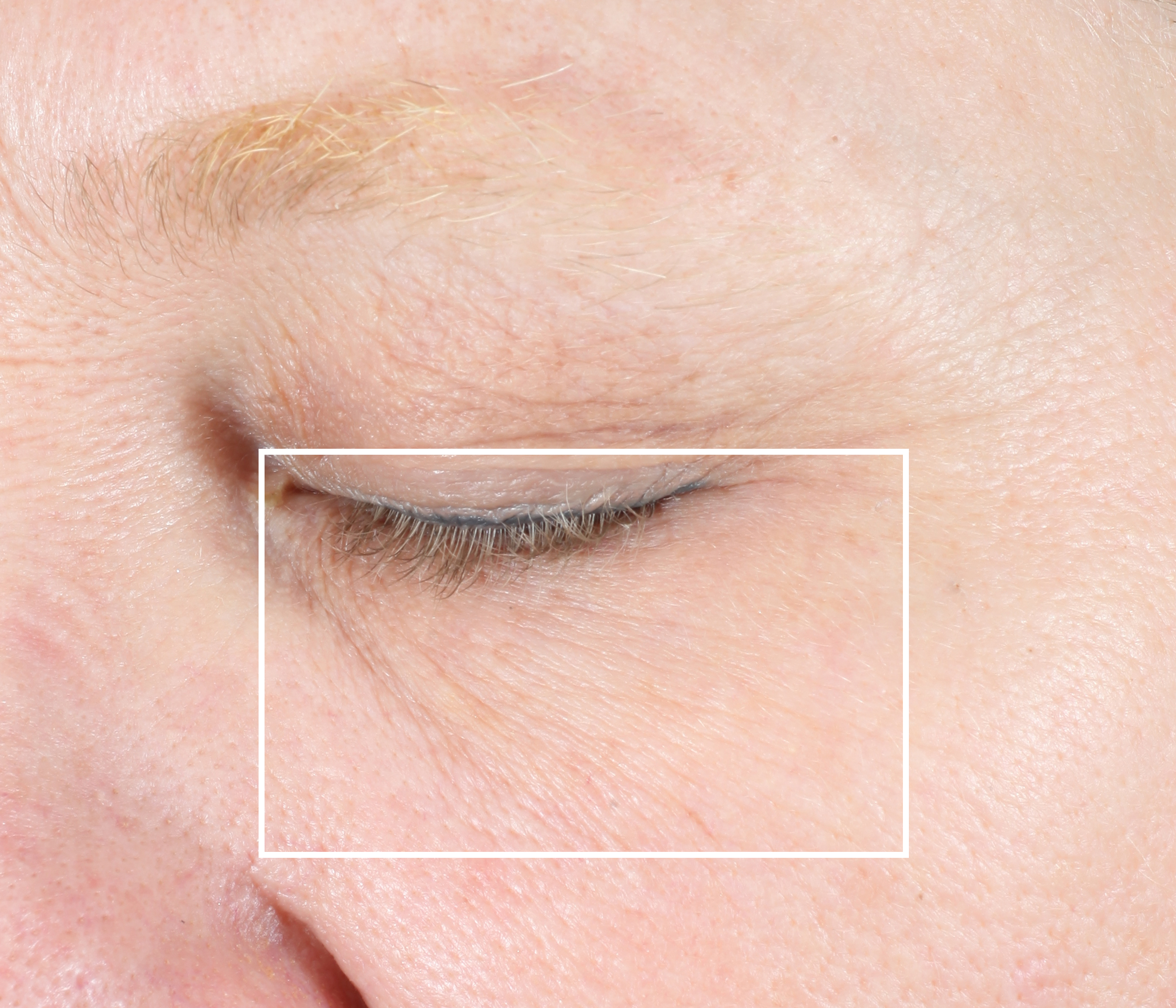 NuFACE FIX Line Smoothing Device FIX Reviews