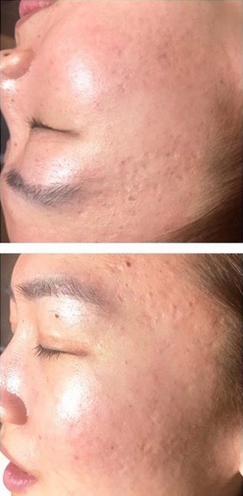 Before and After Laser Genesis Facial. Before: Pock marks and acne scars on the face.
