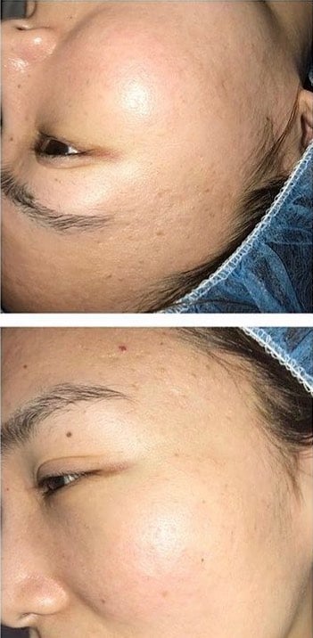 Before and After Laser Genesis Facial. After: Pock marks and acne scars are reduced in appearance.