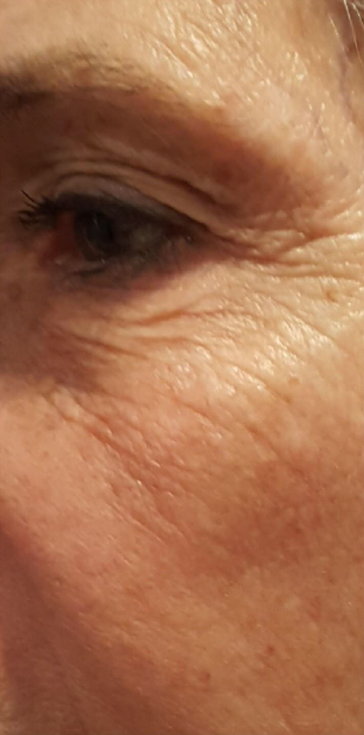 Before and After Forma Skin Tightening. Before: Fine lines around eyes. Crow feet also present around the eyes.