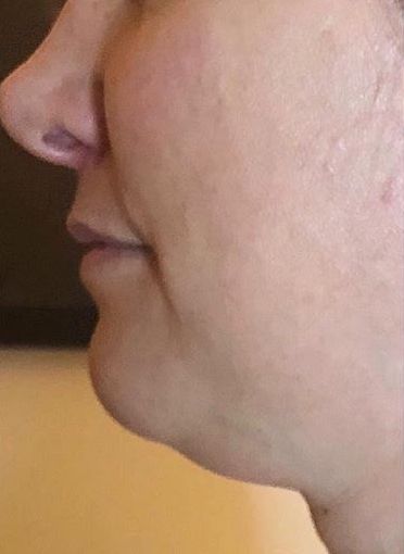 Before and After Forma Skin Tightening. Before: Sagging skin on jowls and presence of a double chin.
