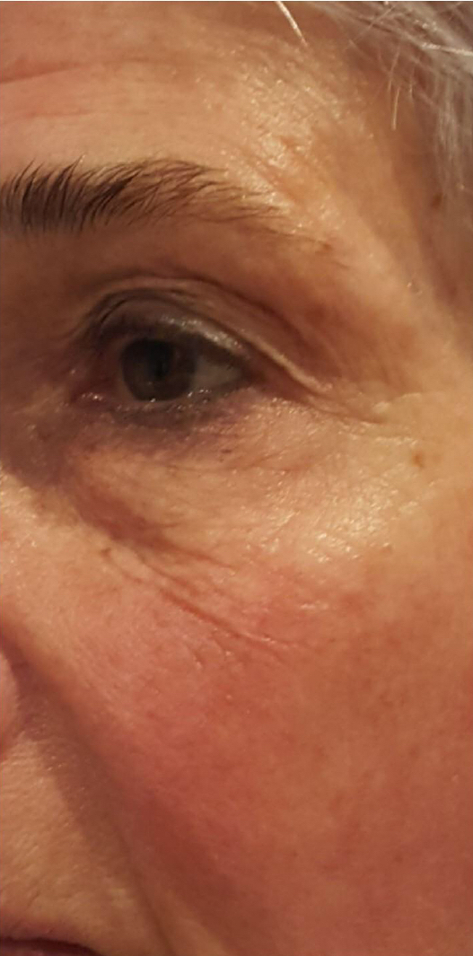 Before and After Forma Skin Tightening. After: Fine lines and wrinkles, including crow's feet, are reduced.