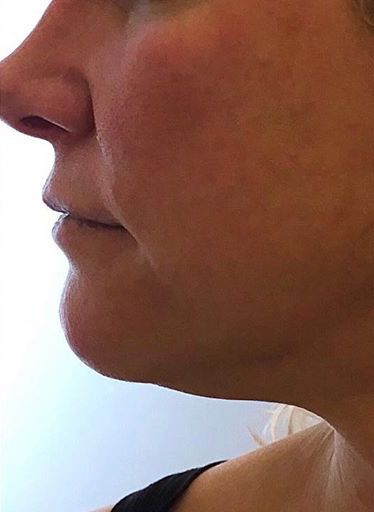Before and After Forma Skin Tightening. Before: Skin on jowls and double chin is tightened without invasive procedures.