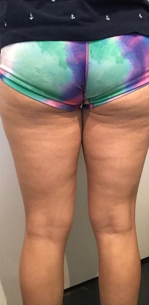 Before and After. Before: Skin on back of legs is uneven with cellulite and lacks tone.