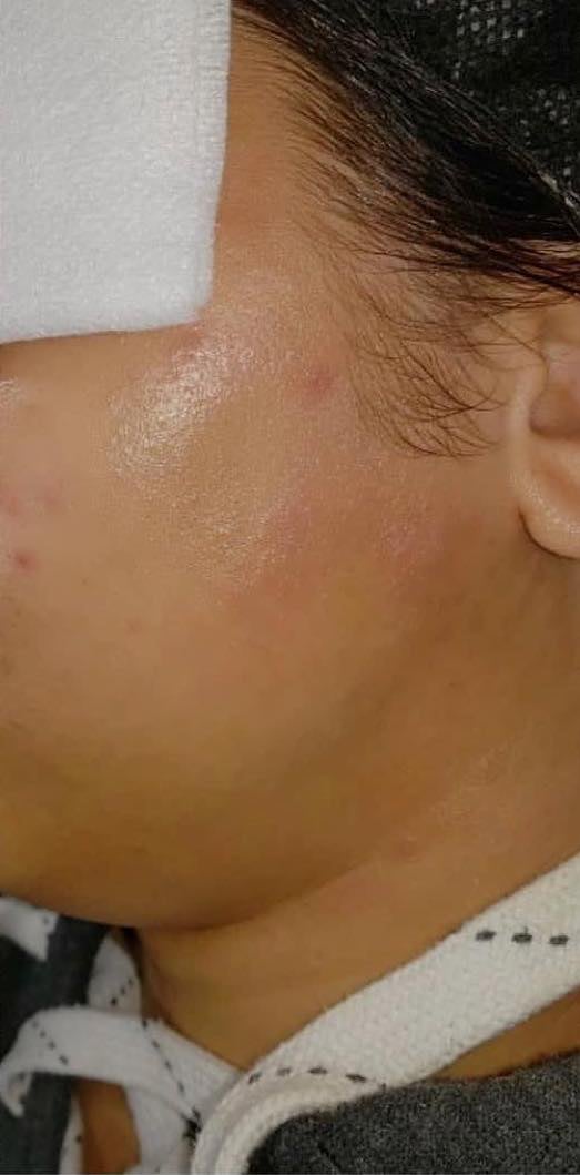 Before and After Dermaplaning. After: Unwanted hair is removed revealing smoother, softer skin.