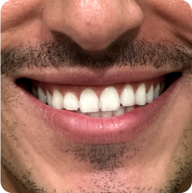 smiling mouth before teeth whitening procedure