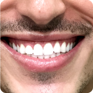 smiling mouth after teeth whitening procedure
