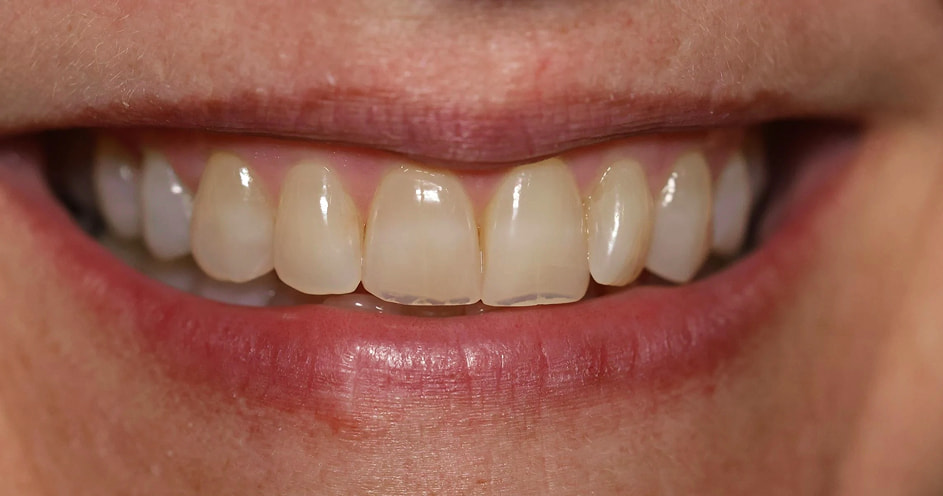 Savina B before treatment