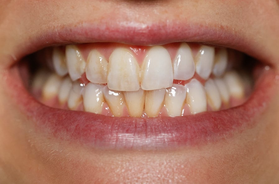 Maggie K. before treatment