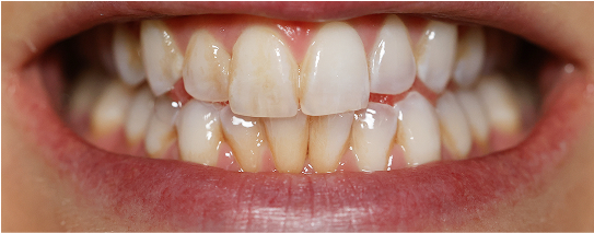 Teeth before Radiate treatment