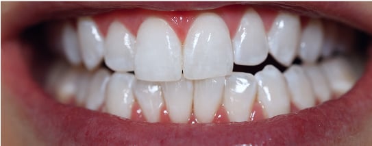 Teeth after Radiate treatment