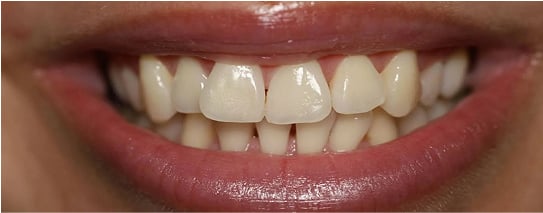 Priscilla's mouth before treatment