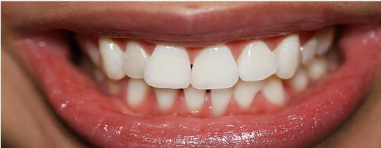 Priscilla's teeth after whitening treatment