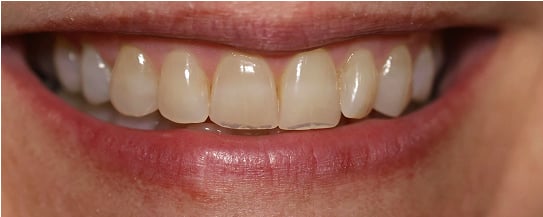 Jordan's teeth before treatment