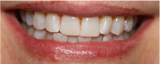 Jordan's teeth after whitening treatment