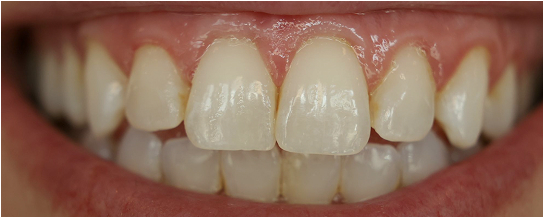 Erin's teeth before treatment