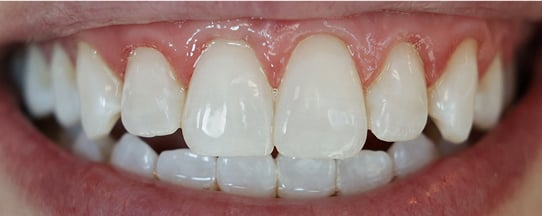 Erin's teeth after whitening treatment