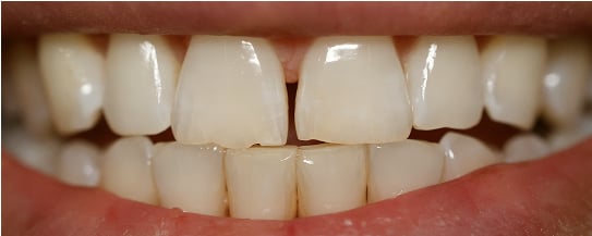 James' teeth before treatment