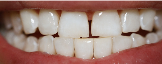 James' teeth after treatment
