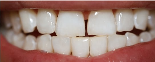 James' teeth after treatment