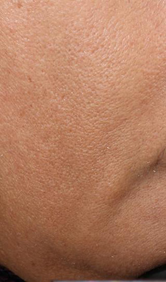 jawline before nuface