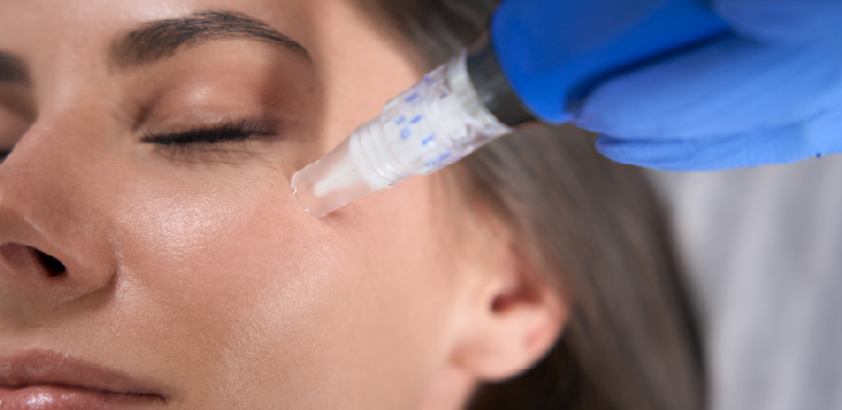 Professional performing microneedling facial treatment to stimulate collagen and prepare the skin for Celluma red light therapy.