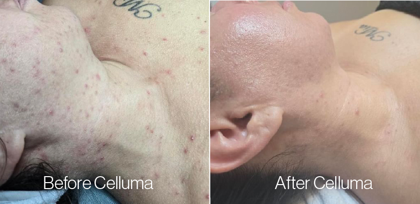 Before and after Celluma LED light therapy showing visible acne reduction and smoother, radiant skin after microneedling treatment.