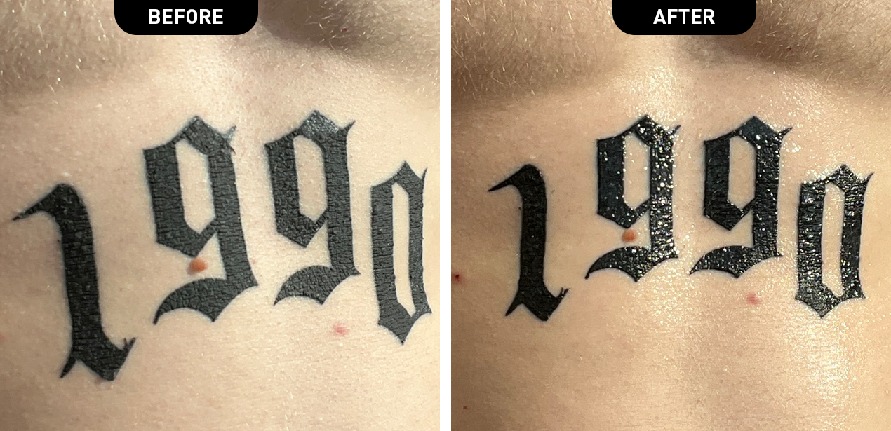 Before and After Tattoo Removal - Get the Best Results the All-Natural Way  | Tattoo Vanish | Laser tattoo removal, Tattoo removal, Laser tattoo