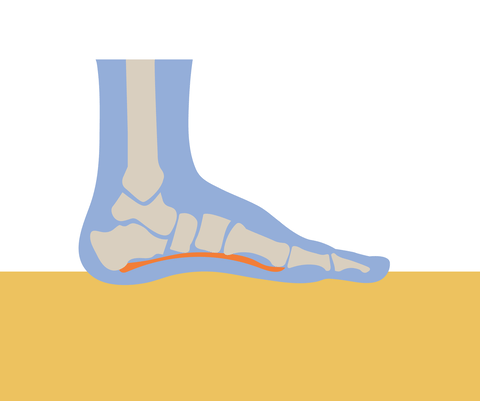 Plantar Fasciitis: Causes, Definition, and Treatment