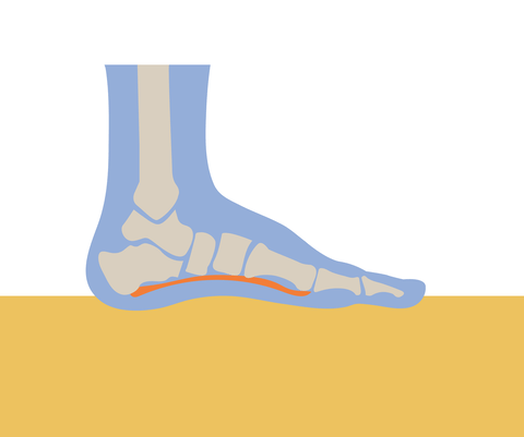 Plantar fasciitis 2025 from flat feet