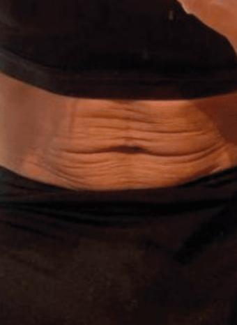 Before Morpheus8 Body