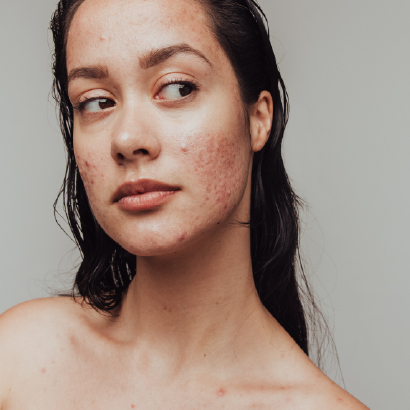 Woman showing skin affected by acne on her cheeks and chin.