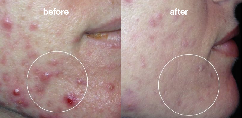 Before and after image depicting a woman with chronic acne. Patient received a Celluma LED light therapy protocol for four weeks showing significantly clearer skin and reduced acne blemishes.