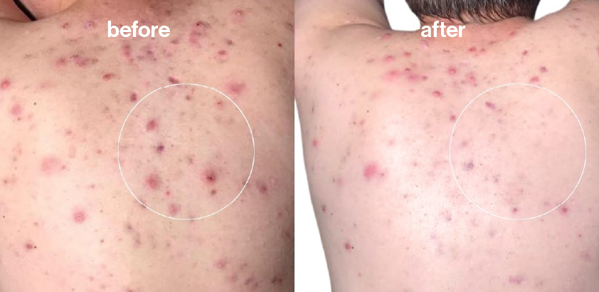 Before and after image depicting a man with back acne. Patient received multiple treatments for acne using combination red and blue light therapy with the full-body Celluma DELUX LED light therapy device.