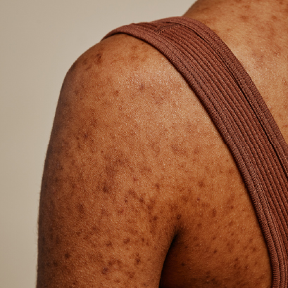 Woman showing acne scars and blemishes on her back and shoulders.