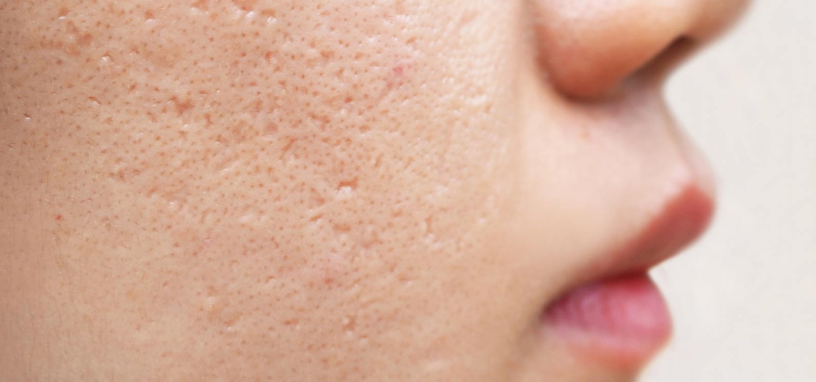 How to treat acne scars - An overview of treatment options