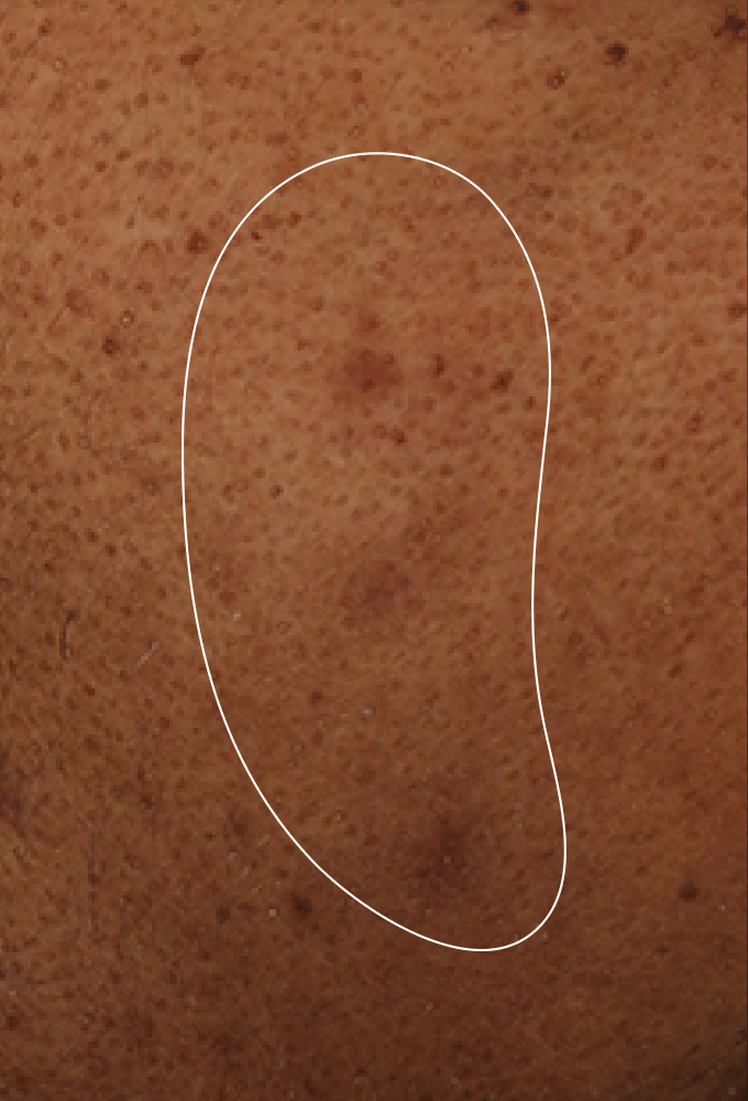 CONSIDERATIONS FOR ACNE-PRONE SKIN
