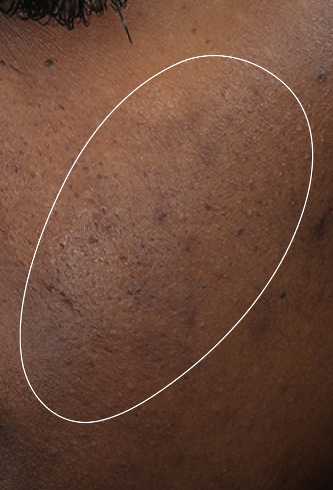 CONSIDERATIONS FOR ACNE-PRONE SKIN
