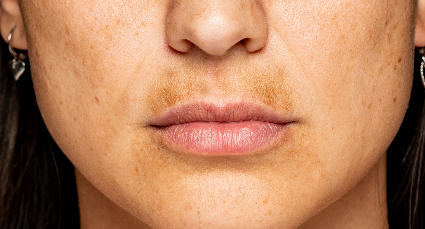 MELASMA: WHAT TO LOOK FOR AND WHAT TO DO