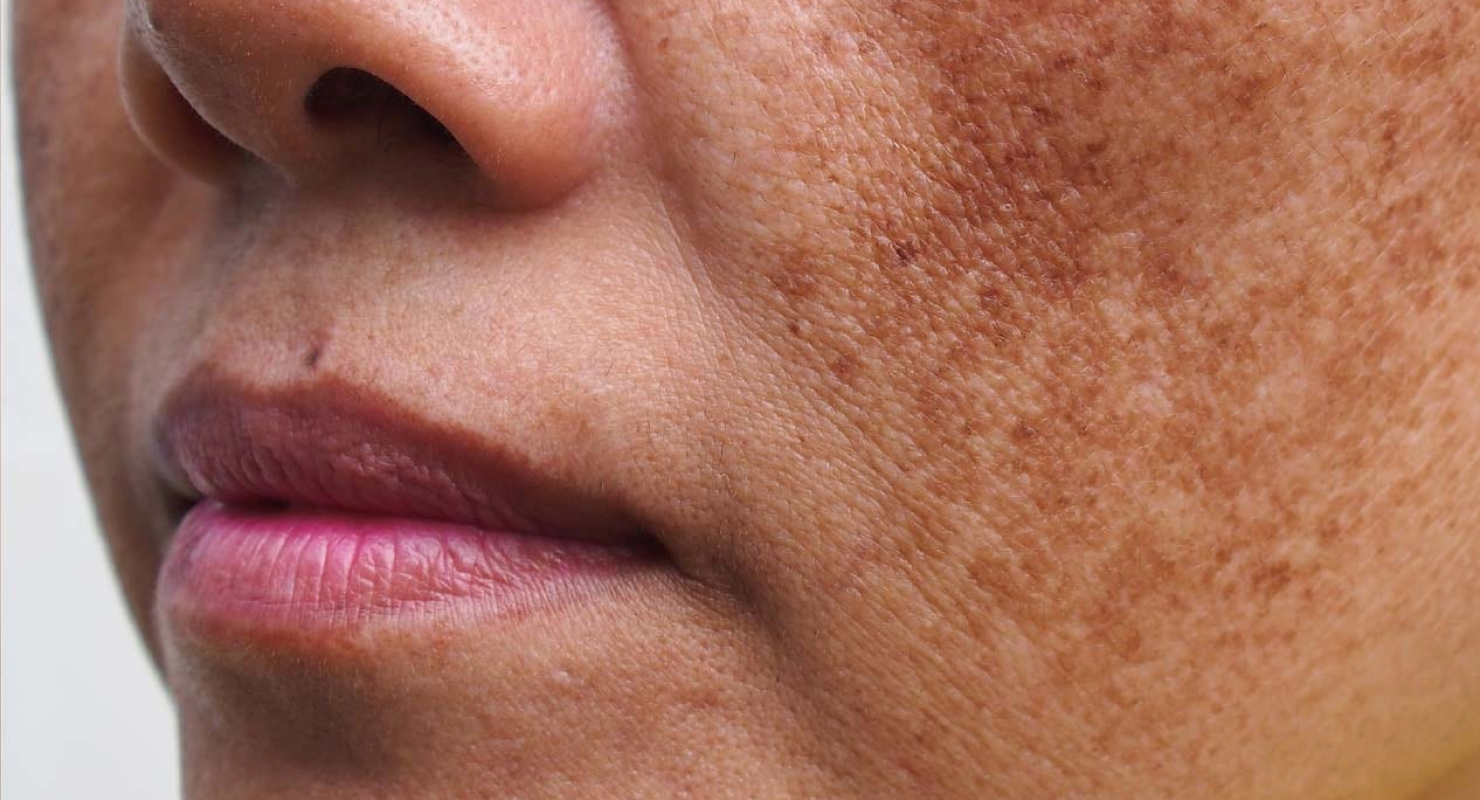 MELASMA: WHAT TO LOOK FOR AND WHAT TO DO