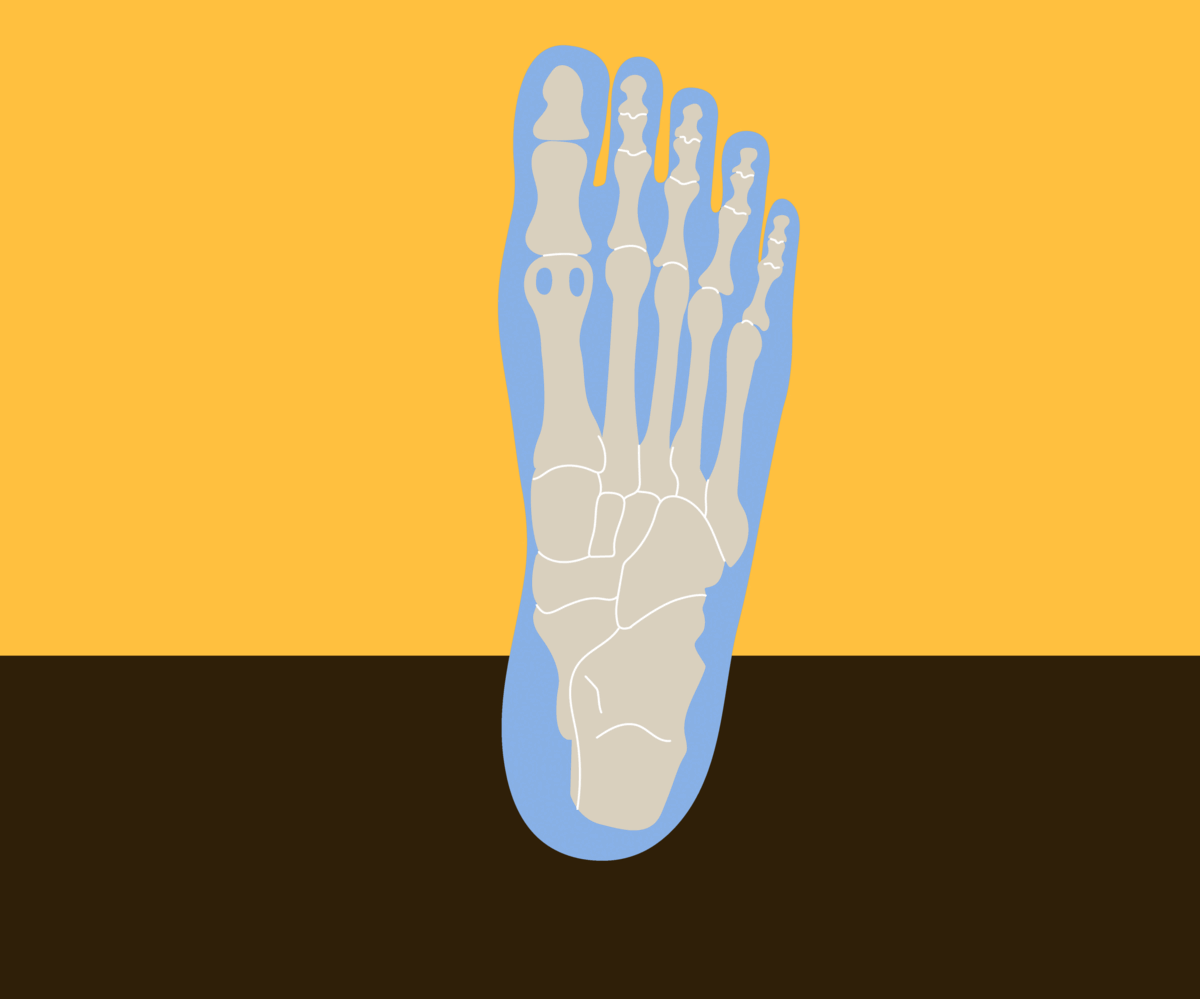 What is Morton's Neuroma