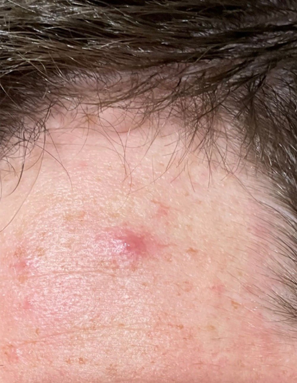 Cardon Skincare's Prickly Patch before acne photo
