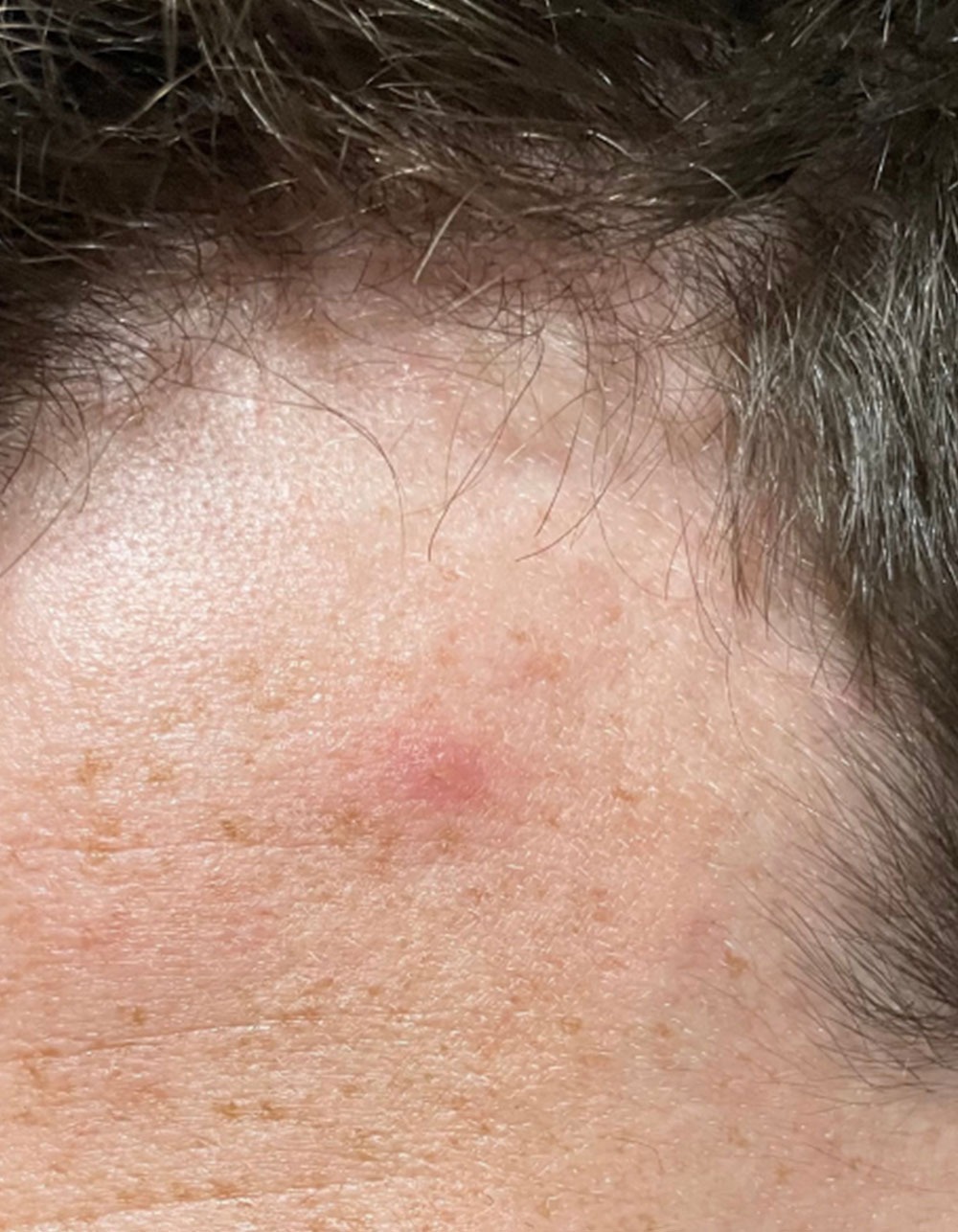 Cardon Skincare's Prickly Patch after acne photo