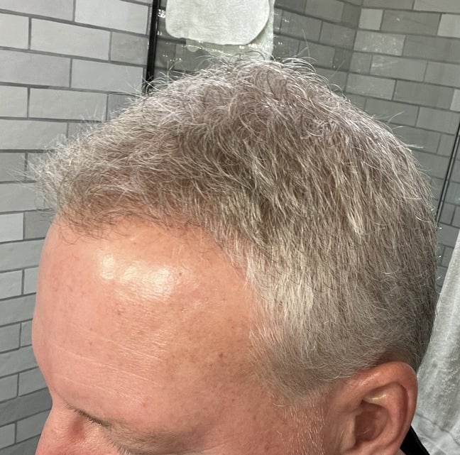 Cardon Real Hair Growth Results After