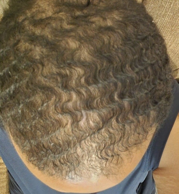 Cardon Real Hair Growth Results Before