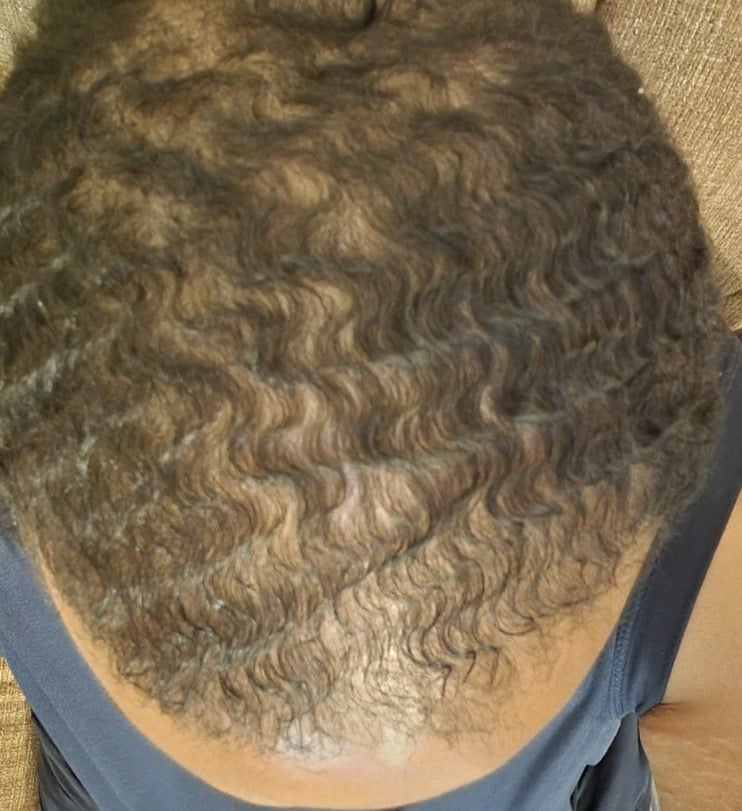 Cardon Real Hair Growth Results Before